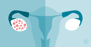 Ayurvedic treatment for PCOS