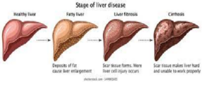 Stages of Cirhhosis